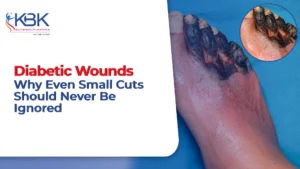 diabetic wounds