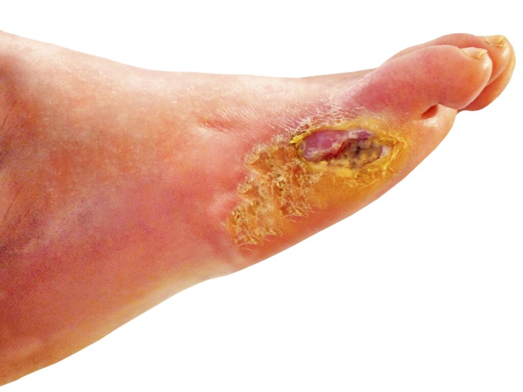 Medical treatment for diabetic foot infections and ulcers