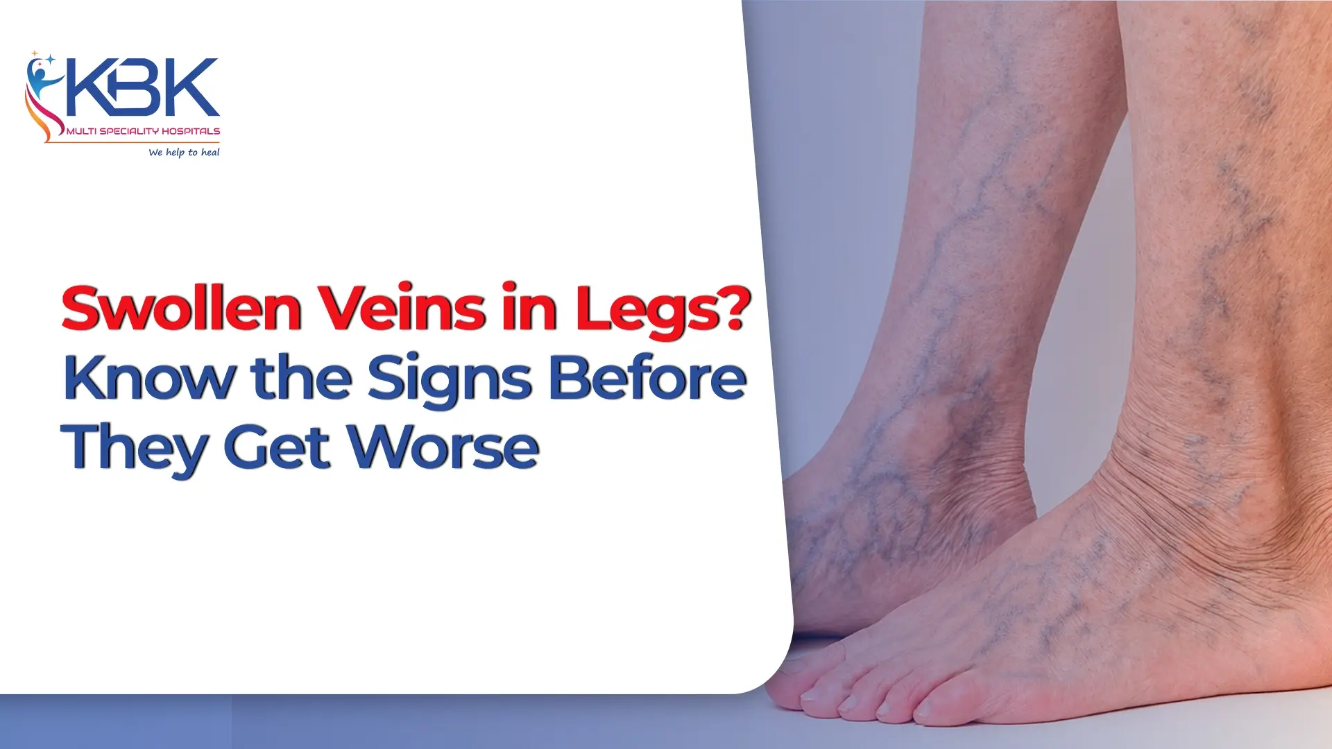 visible veins in legs