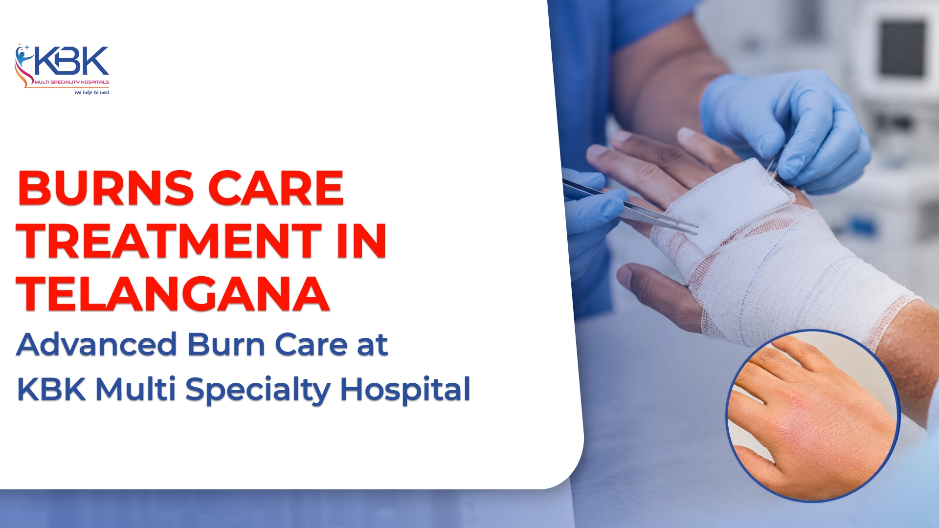 Burns Care Treatment in Telangana – Advanced Burn Care at KBK Multi Specialty Hospital 