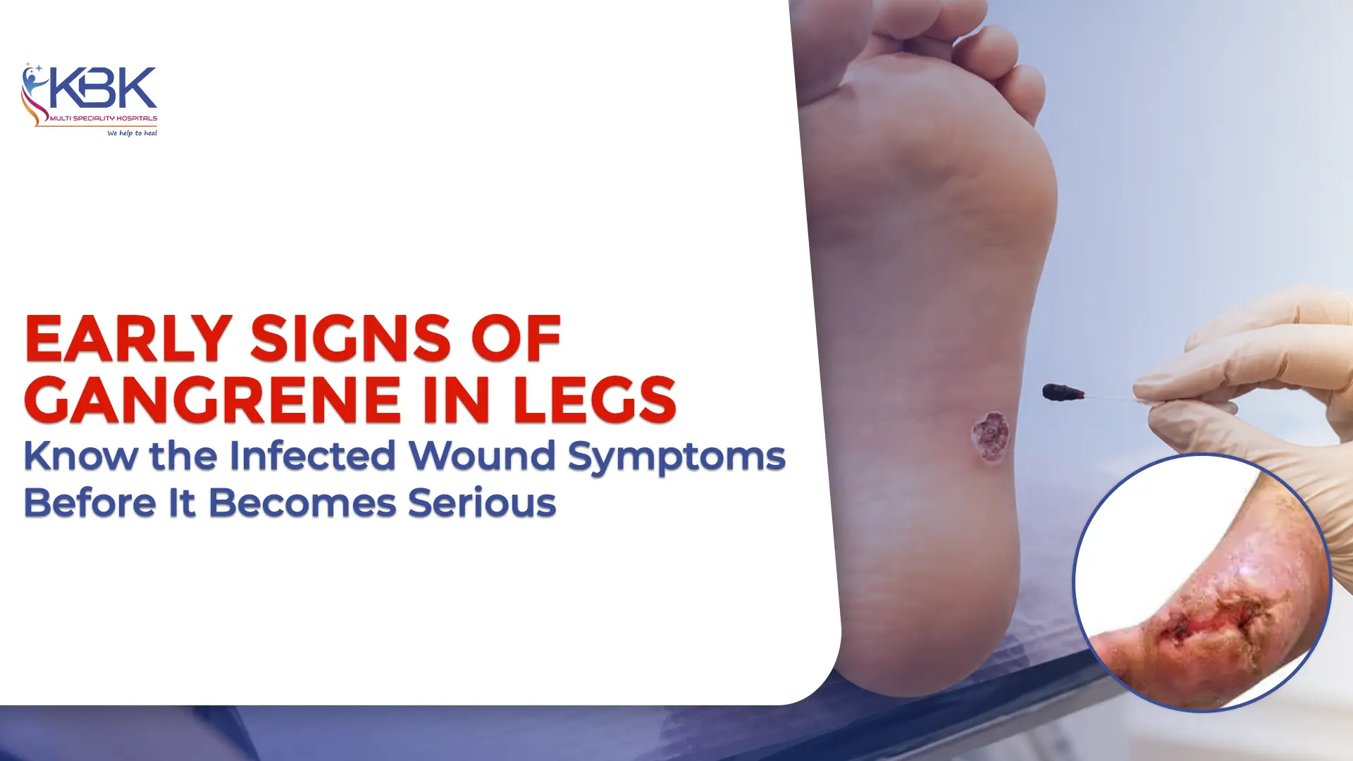 Early Signs of Gangrene in Legs You Should Never Ignore