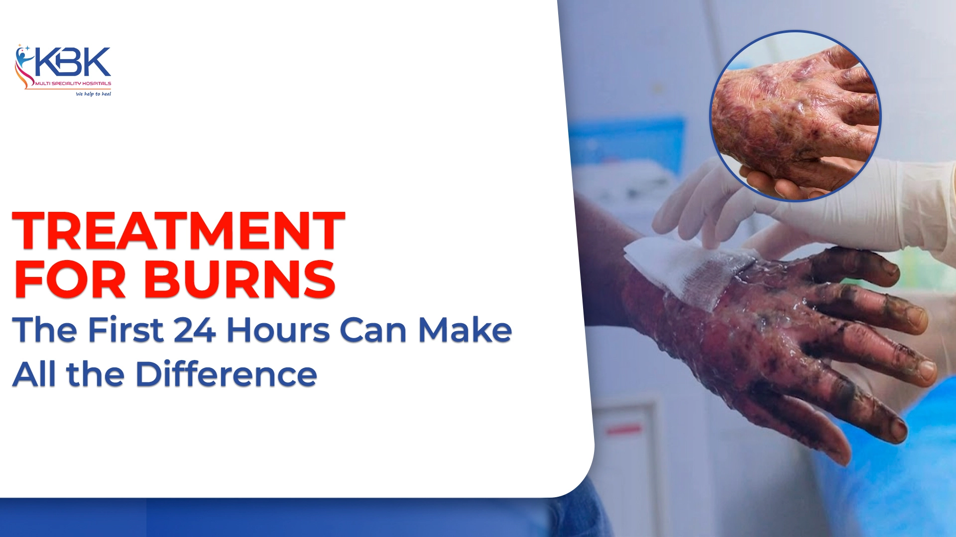 Treatment for burns