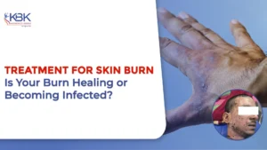 treatment for skin burn