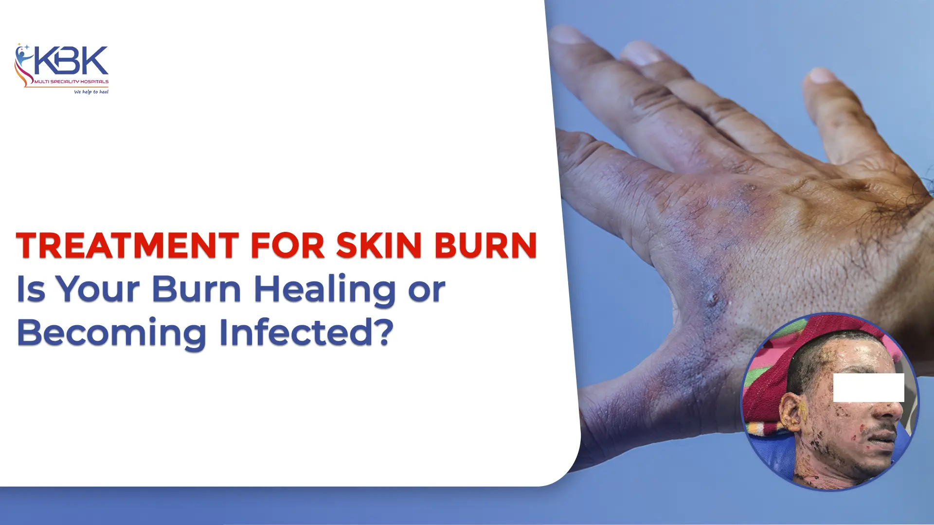 treatment for skin burn